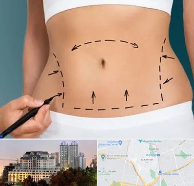 عمل ابدومینوپلاستی در فرشته