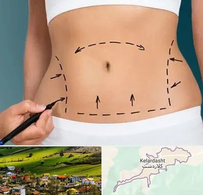 عمل ابدومینوپلاستی در کلاردشت