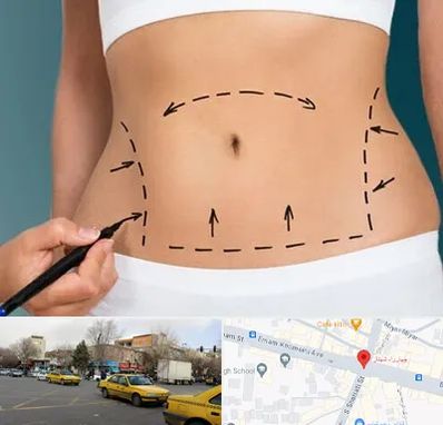 عمل ابدومینوپلاستی در شهناز تبریز