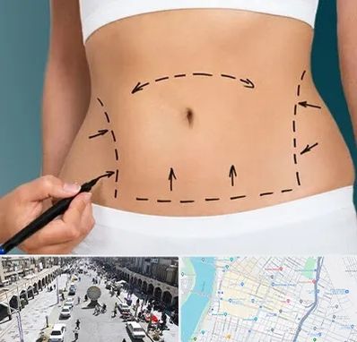 عمل ابدومینوپلاستی در نادری اهواز