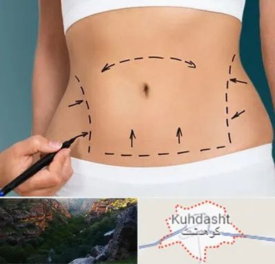 عمل ابدومینوپلاستی در کوهدشت