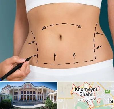 عمل ابدومینوپلاستی در خمینی شهر