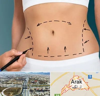 عمل ابدومینوپلاستی در اراک