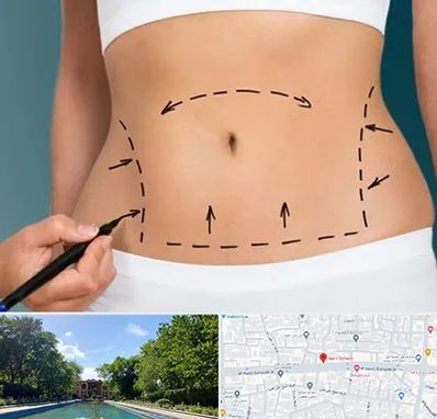 عمل ابدومینوپلاستی در هشت بهشت اصفهان