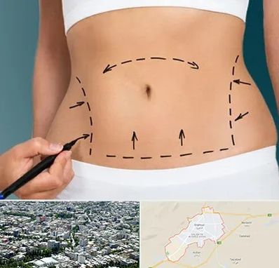 عمل ابدومینوپلاستی در شاهرود