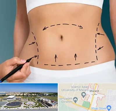 عمل ابدومینوپلاستی در ملارد