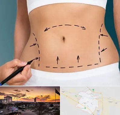 عمل ابدومینوپلاستی در قوچان