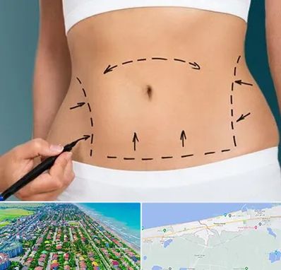 عمل ابدومینوپلاستی در فریدونکنار