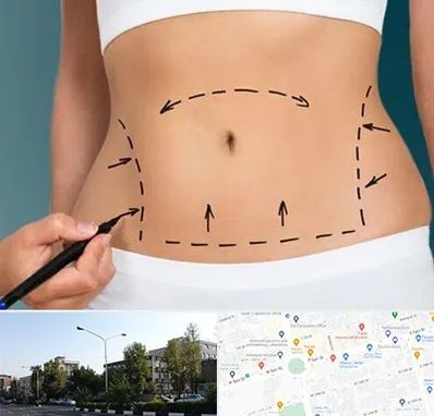 عمل ابدومینوپلاستی در میدان کاج