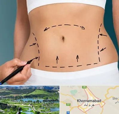 عمل ابدومینوپلاستی در خرم آباد