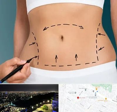 عمل ابدومینوپلاستی در هفت تیر مشهد