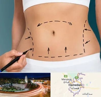 عمل ابدومینوپلاستی در همدان