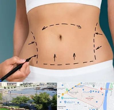 عمل ابدومینوپلاستی در گلستان اهواز