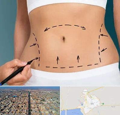 عمل ابدومینوپلاستی در بندر ماهشهر