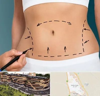 عمل ابدومینوپلاستی در شاهین شهر