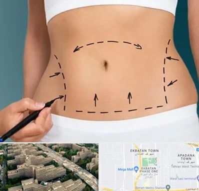 عمل ابدومینوپلاستی در اکباتان