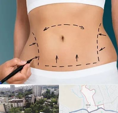 عمل ابدومینوپلاستی در اوین