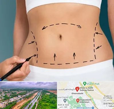 عمل ابدومینوپلاستی در قصرالدشت شیراز