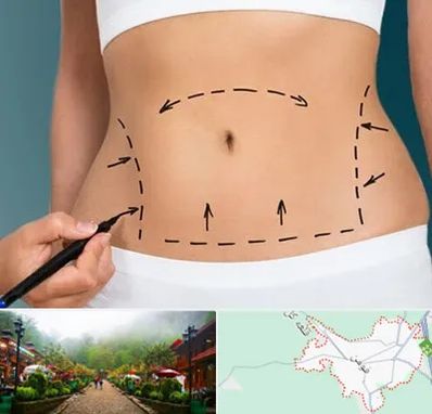 عمل ابدومینوپلاستی در فومن