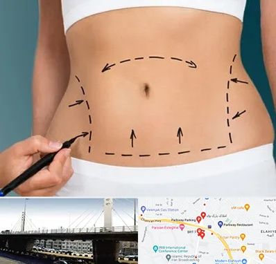 عمل ابدومینوپلاستی در پارک وی