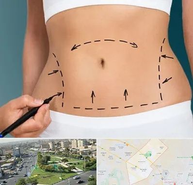 عمل ابدومینوپلاستی در کمال شهر کرج