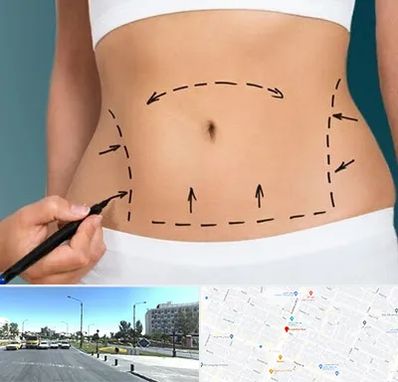 عمل ابدومینوپلاستی در بلوار کلاهدوز مشهد