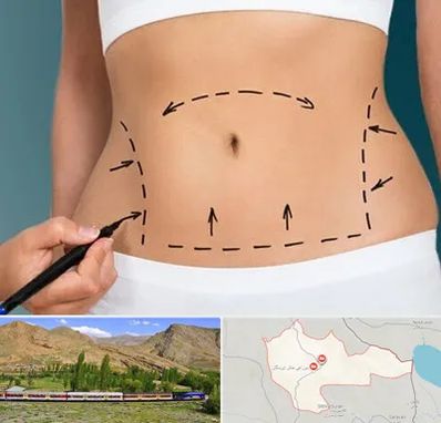 عمل ابدومینوپلاستی در خاش