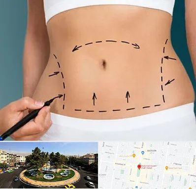 عمل ابدومینوپلاستی در هفت حوض