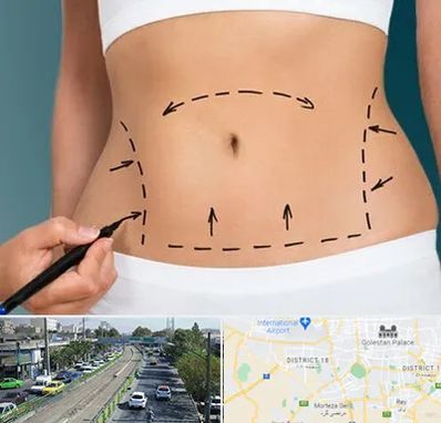 عمل ابدومینوپلاستی در جنوب تهران