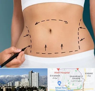 عمل ابدومینوپلاستی در شهرک غرب تهران