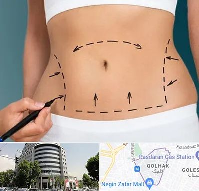 عمل ابدومینوپلاستی در قلهک