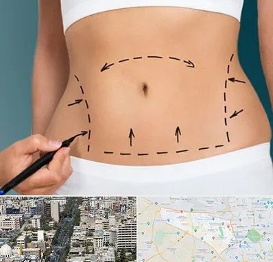 عمل ابدومینوپلاستی در منطقه 18 تهران