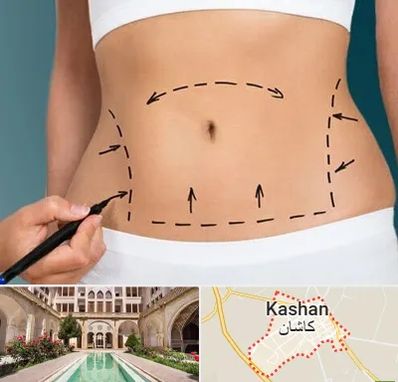 عمل ابدومینوپلاستی در کاشان