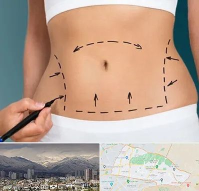 عمل ابدومینوپلاستی در منطقه 4 تهران