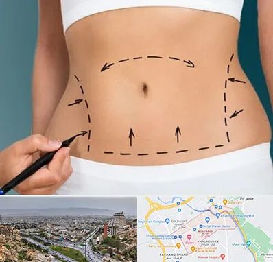 عمل ابدومینوپلاستی در معالی آباد شیراز