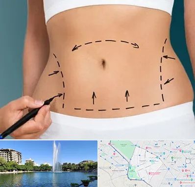 عمل ابدومینوپلاستی در کوهسنگی مشهد