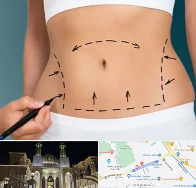 عمل ابدومینوپلاستی در زرگری شیراز