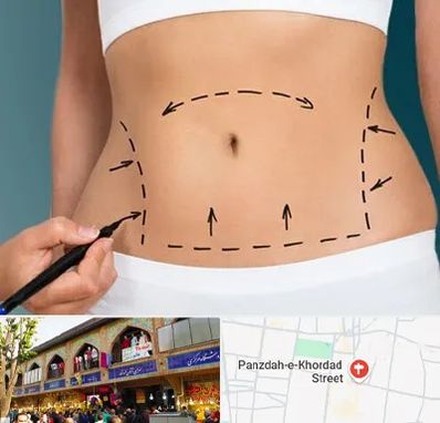 عمل ابدومینوپلاستی در 15 خرداد