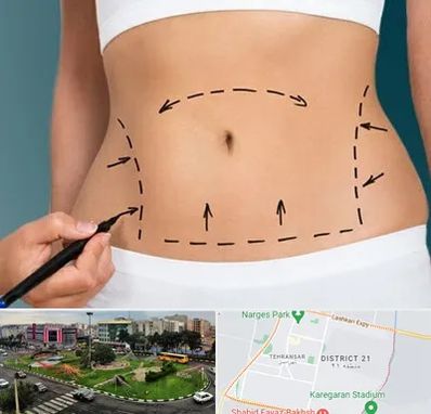 عمل ابدومینوپلاستی در تهرانسر