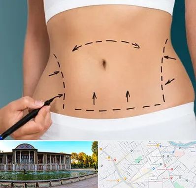 عمل ابدومینوپلاستی در عفیف آباد شیراز