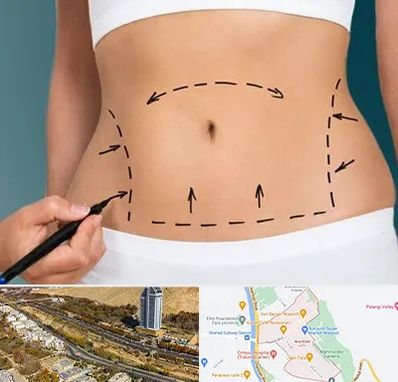 عمل ابدومینوپلاستی در خیابان نیایش شیراز