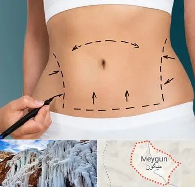 عمل ابدومینوپلاستی در میگون