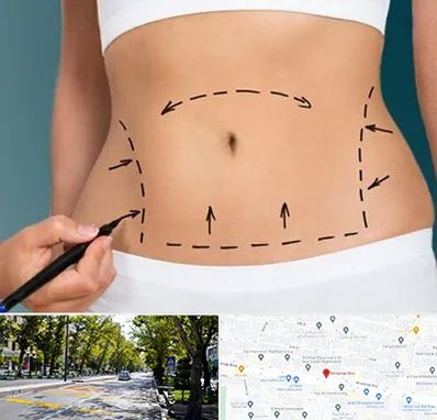 عمل ابدومینوپلاستی در میرداماد