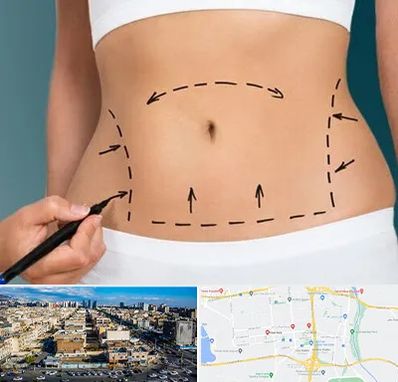 عمل ابدومینوپلاستی در شهرک راه آهن