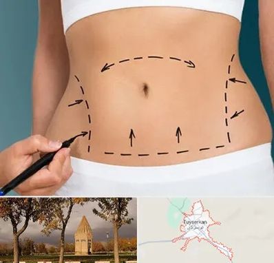 عمل ابدومینوپلاستی در تویسرکان