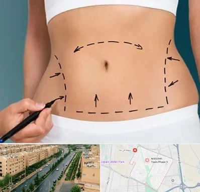 عمل ابدومینوپلاستی در فاز سه اندیشه