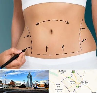 عمل ابدومینوپلاستی در تایباد