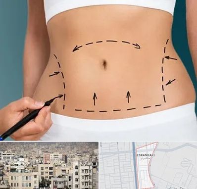 عمل ابدومینوپلاستی در اسکندری