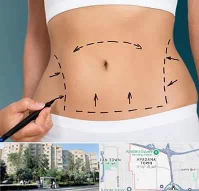 عمل ابدومینوپلاستی در آپادانا