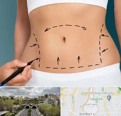 عمل ابدومینوپلاستی در یوسف آباد